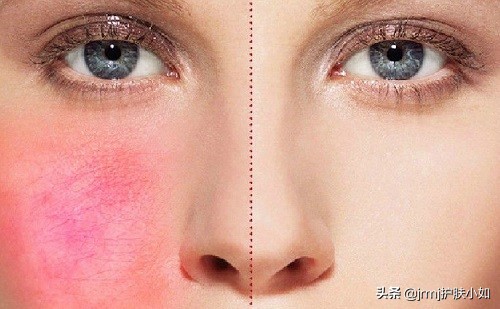 脸部红血丝怎么去除最好的方法,脸部红血丝怎么去除小妙招视频