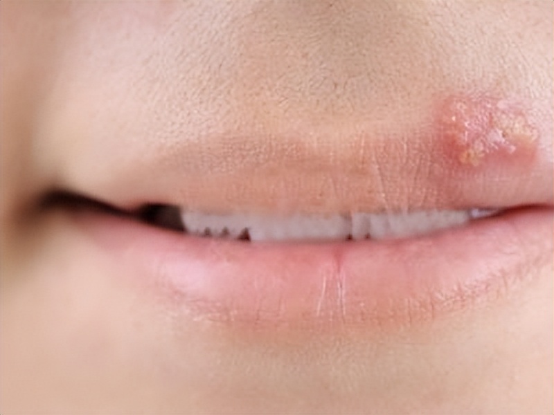 嘴巴周围起一连串的水泡,六岁嘴巴经常起上火的水泡