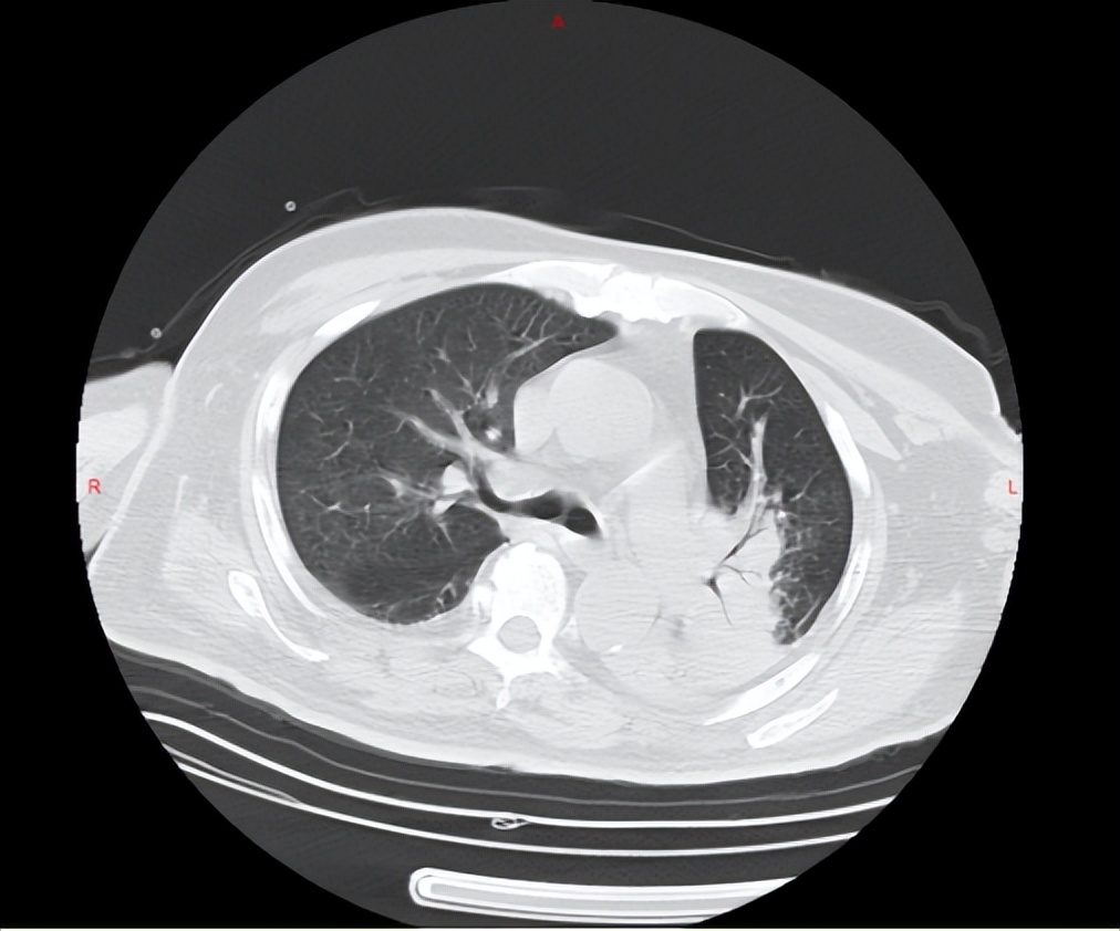 70岁老大爷医直肠癌晚期,六十多岁老人患肠癌坚持二十多年