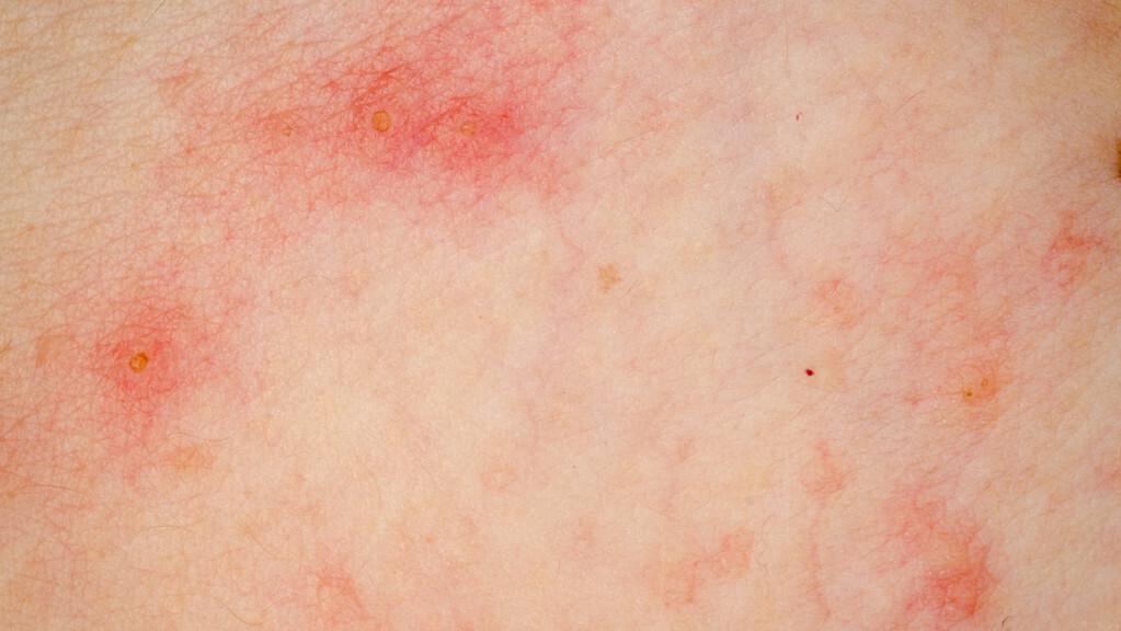 腿上出好多小丘疹是hpv感染吗,腿上痒成片起红疹是感染hpv吗