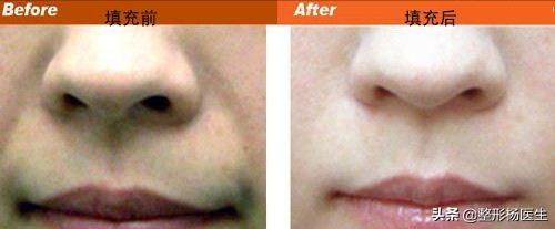 有法令纹特显老教你几招抚平细纹,法令纹这么显老得如何搞定