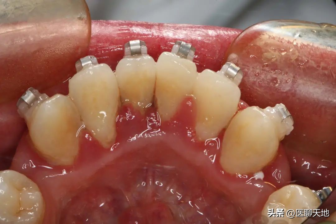 正畸前必须治疗牙周吗,牙周病患者是否能进行正畸治疗