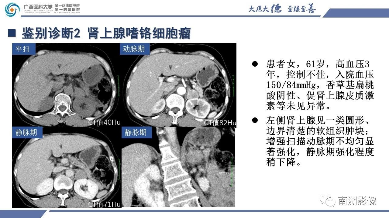 肾上腺海绵状血管瘤,肾上腺血管瘤是良性还是恶性