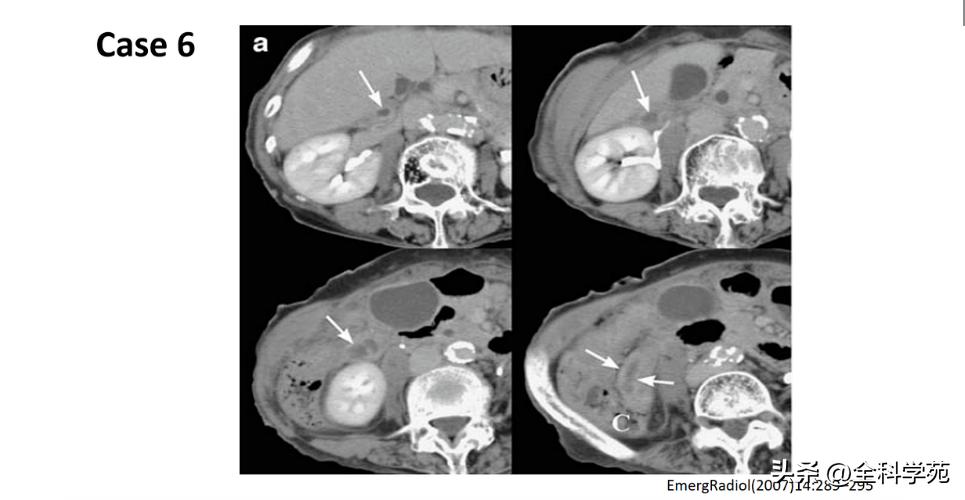 阑尾炎的讲解,关于阑尾炎的讨论总结