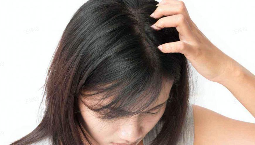 治疗头屑头痒脱发的小妙招,怎么判断是干性头屑还是真菌头屑