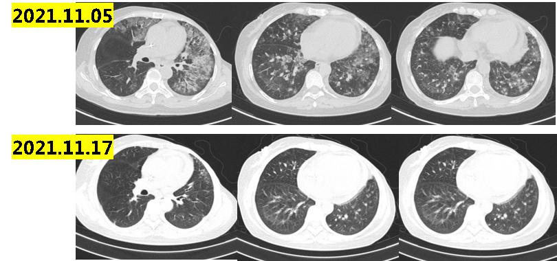 乳腺癌晚期没多少钱怎么治疗最佳,经济困难癌症晚期可以放弃治疗吗