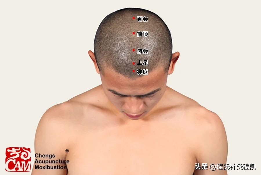 程凯中医养生妙招,程凯养生说针灸前应注意什么