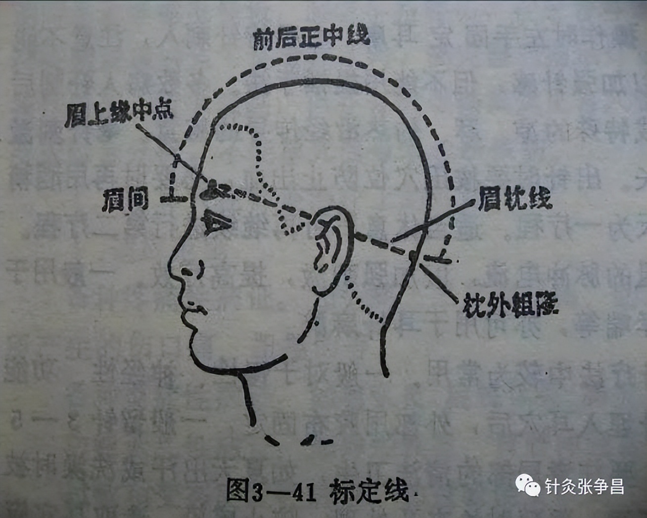 山西省中医院特色疗法焦氏头针,康复针刺运动疗法