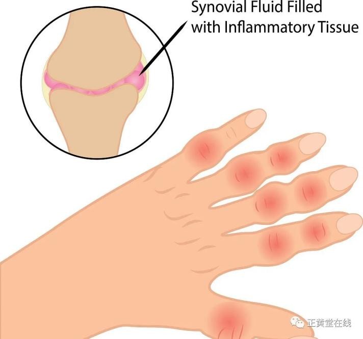 类风湿合并间质性肺炎如何治疗,类风湿合并肺纤维化怎么治