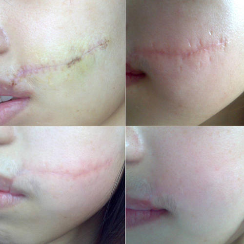 3个月的疤痕增生还能消除吗,莫名其妙长了个增生疤痕