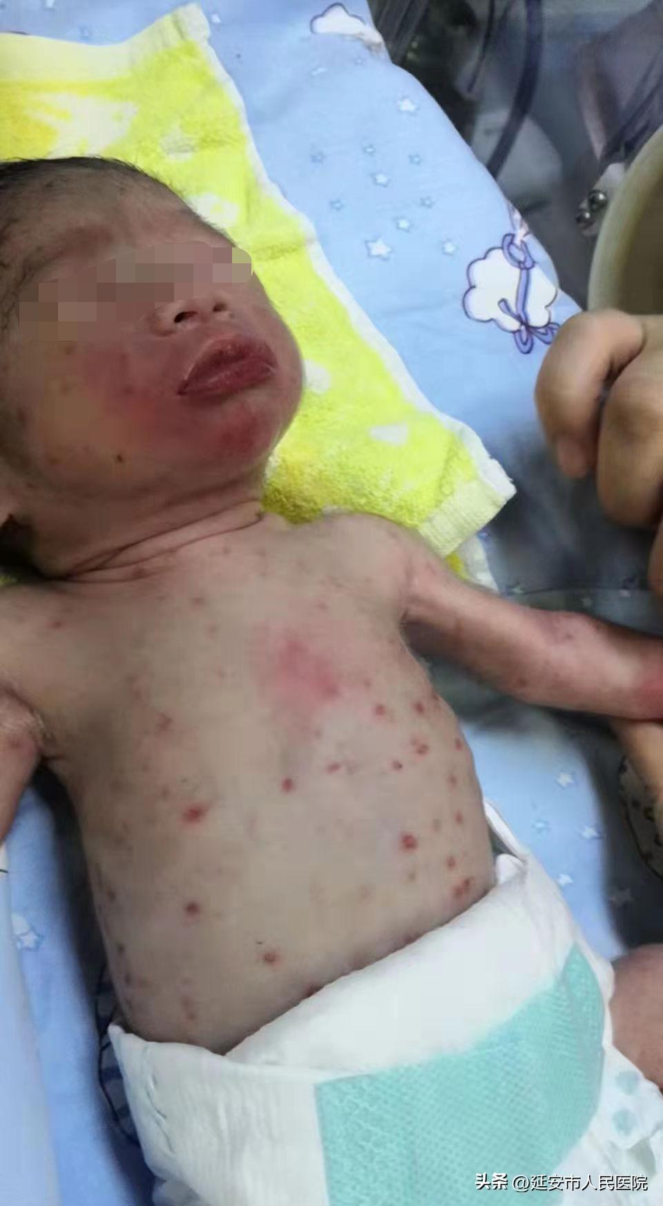 产妇宫腔感染早产宝宝命悬一线，多学科联合救治成功脱险