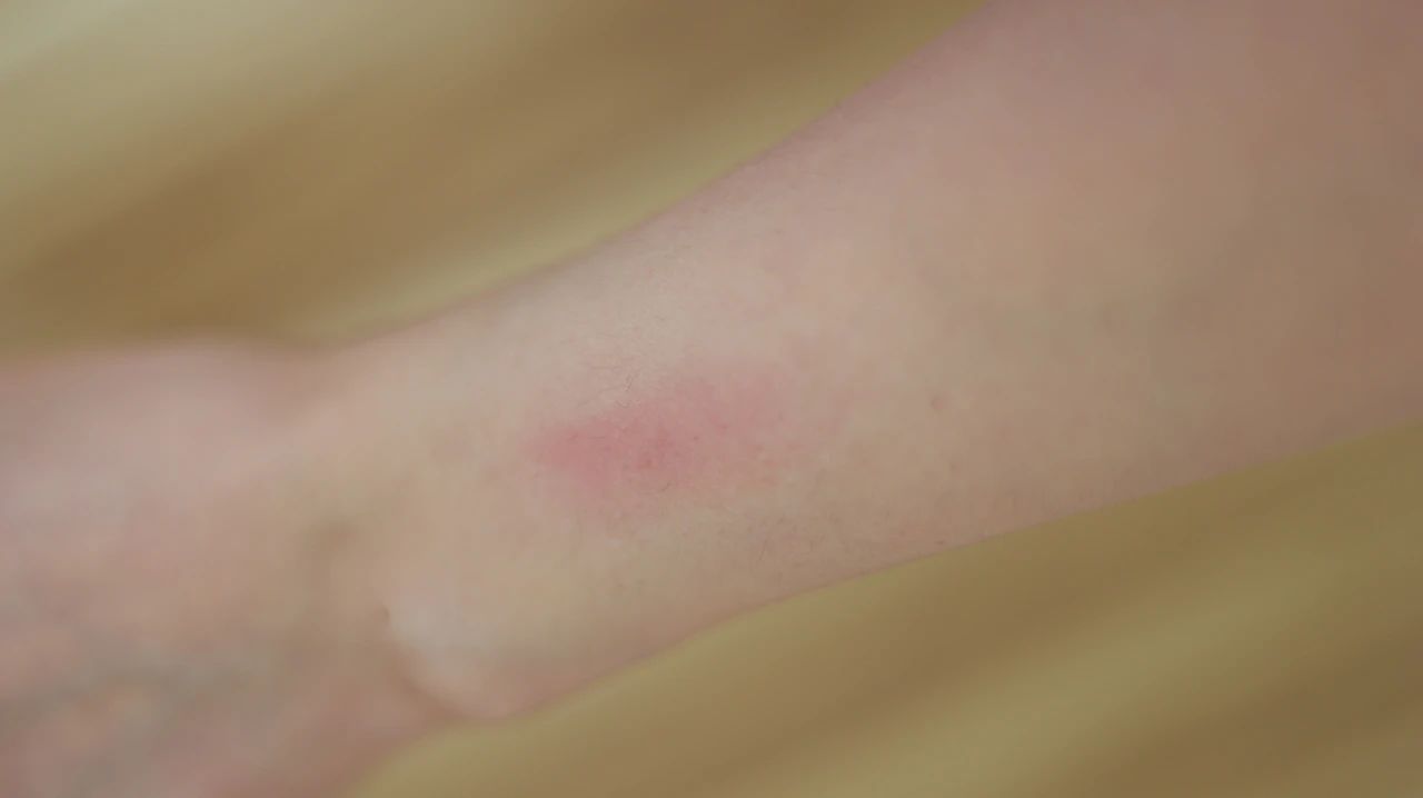 皮肤瘙痒划痕症的治疗方法,皮肤划痕症皮肤老是痒怎么办