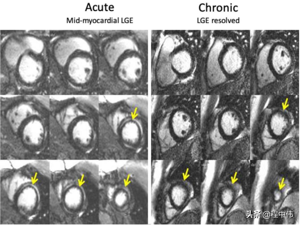 暴发性心肌炎及时发现治疗,最新病毒性心肌炎指南