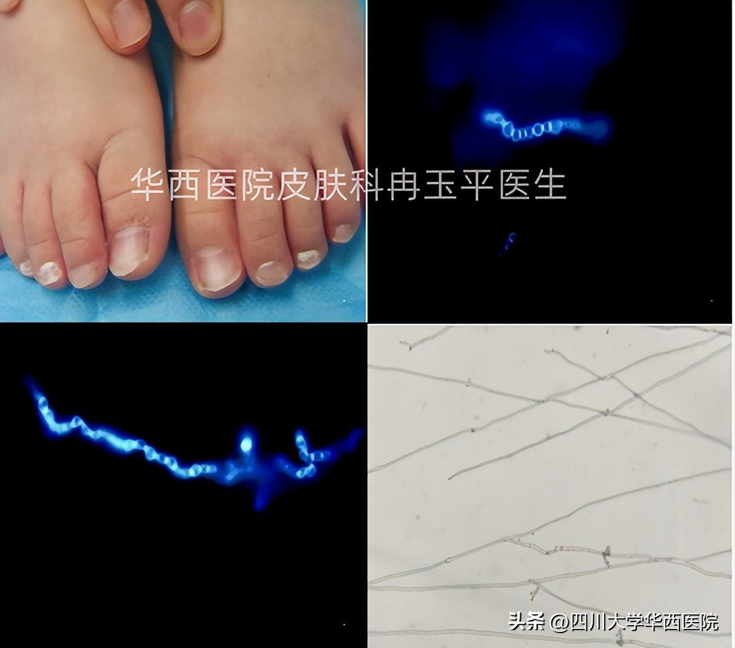 灰指甲是指甲发灰吗,指甲灰色就是灰指甲吗