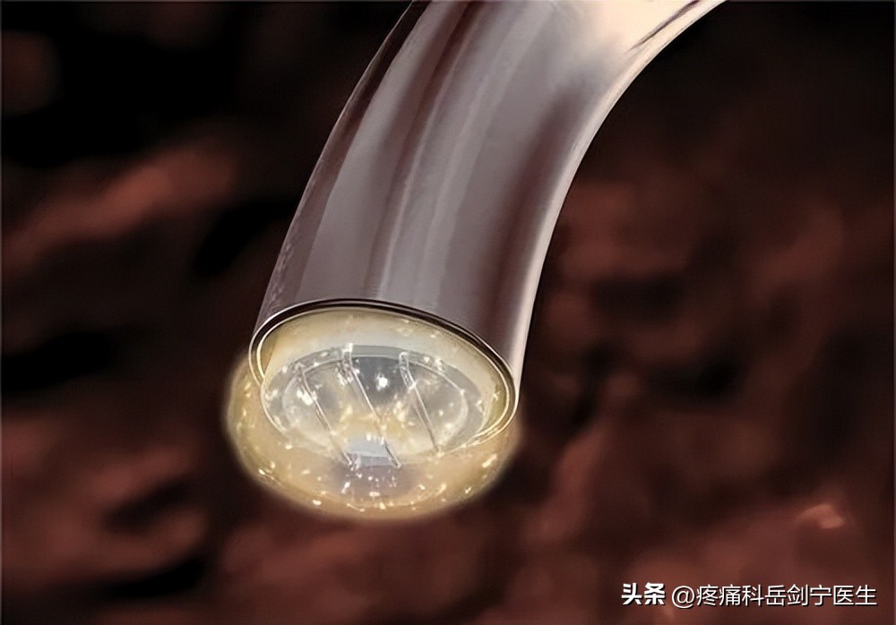 椎间盘突出微创介入疗法图片,椎间盘射频靶点消融术图解