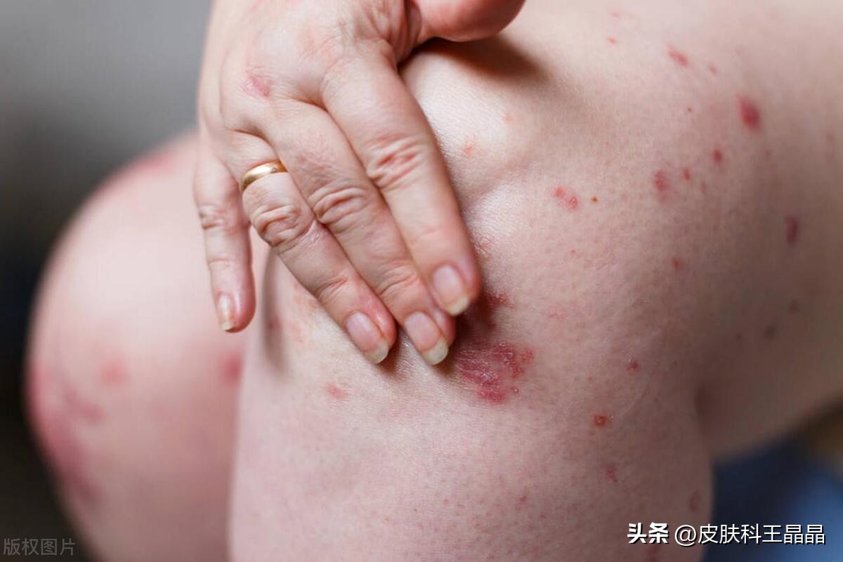 治疗牛皮癣最牛的土方治疗法,治疗牛皮癣最好最便宜的软膏