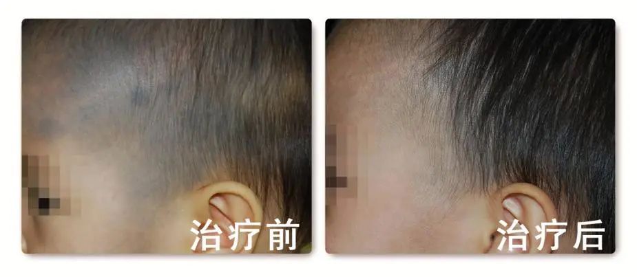 激光打青胎记一般需要几次,1厘米的黑色胎记做激光去除