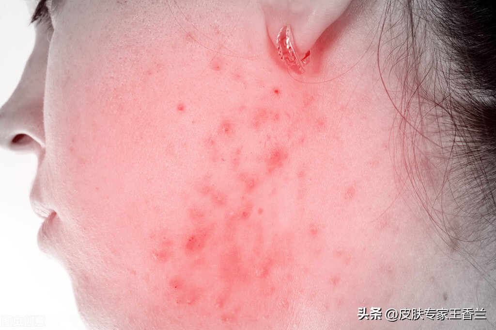 皮肤出油毛孔粗大粉刺黑头痘痘,毛孔粗大油性皮肤长痘痘怎么解决