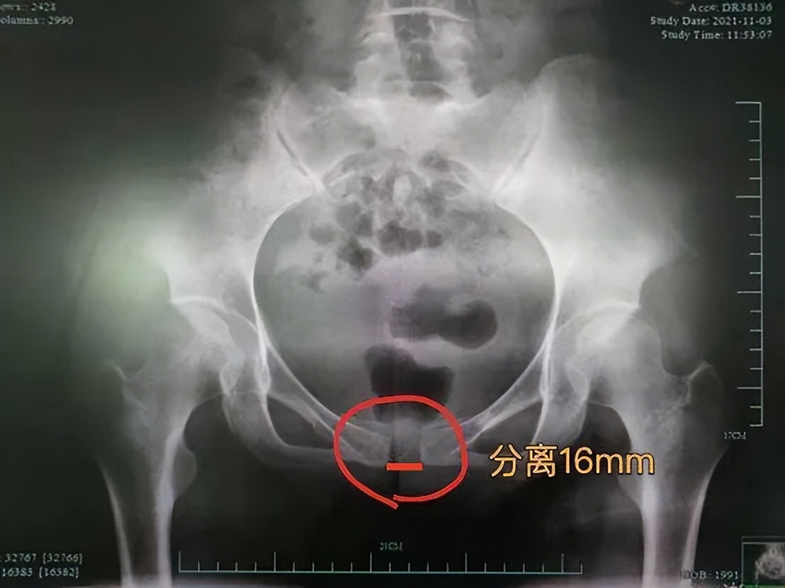 【科普】孕期、产后腰痛，当心这个病！新手宝妈痛到“瘫痪”