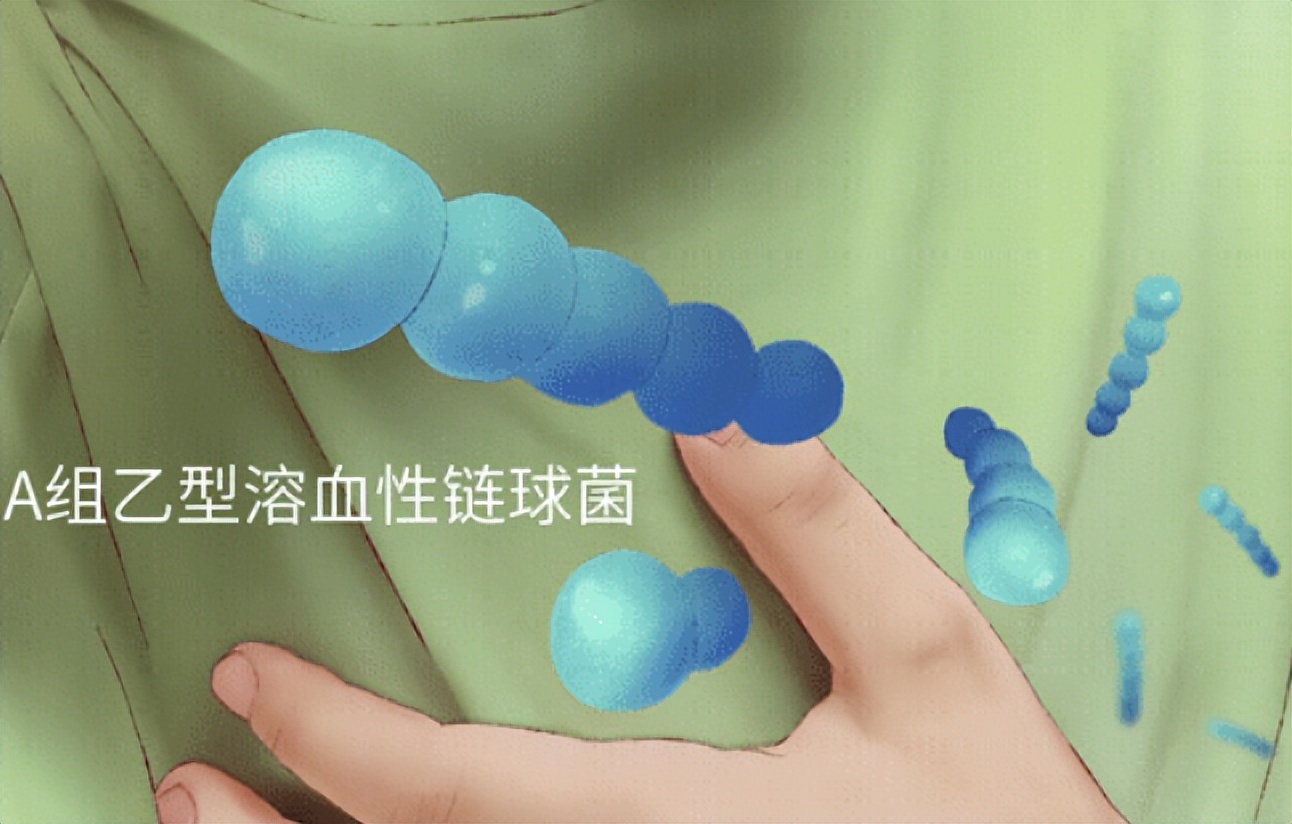 溶血链球菌引起风湿可以根治吗,风湿热溶血性链球菌