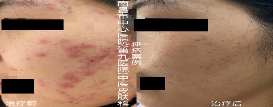 想拥有光滑无痘的脸，别再做这个动作了