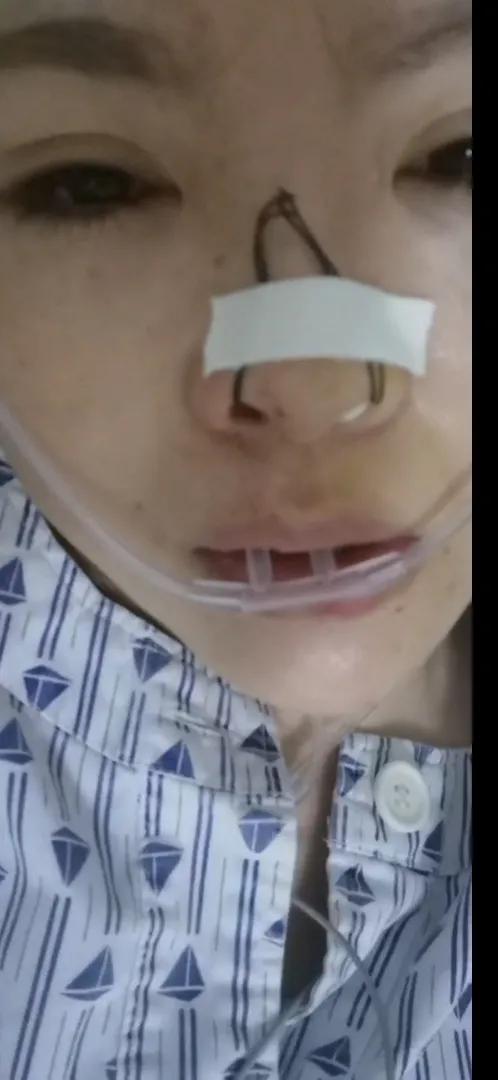 拔牙后第四天伤口能完全愈合了吗,拔牙后可以用口腔呼吸