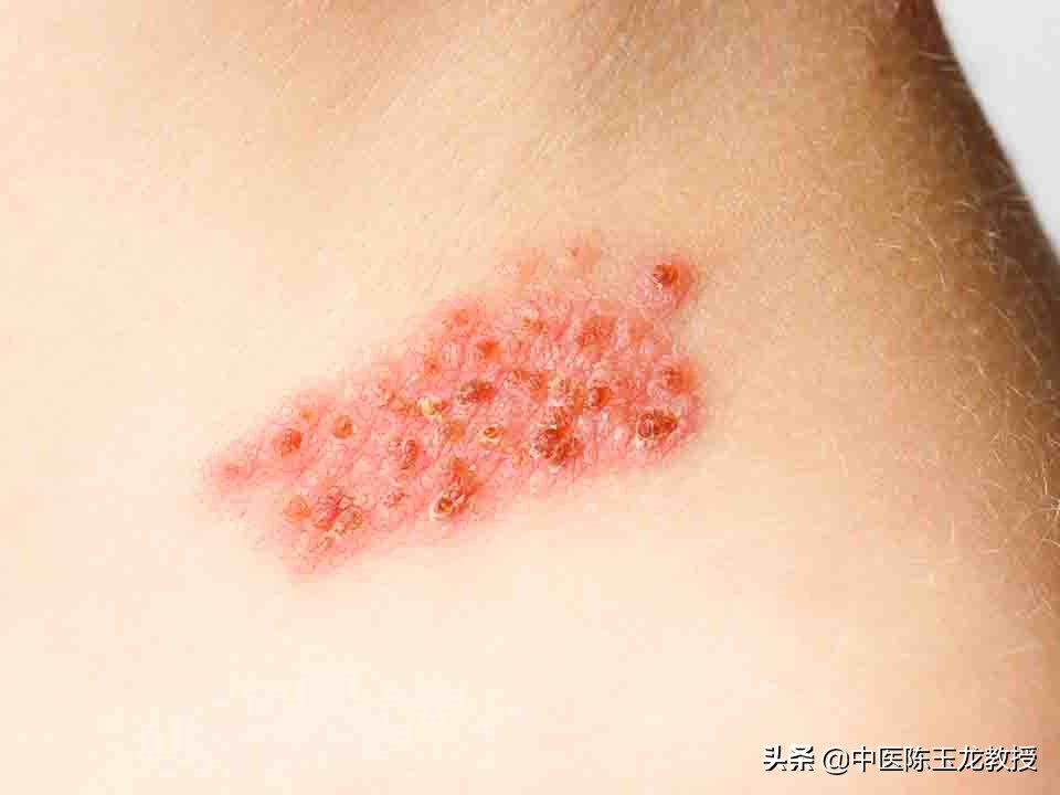 龙胆泻肝丸脂肪肝医案,龙胆泻肝汤治疗皮肤病