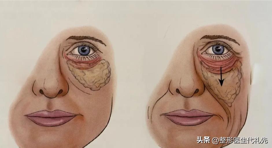 眼袋手术后出现皱纹和凹陷怎么办,祛眼袋手术后凹陷多久恢复好