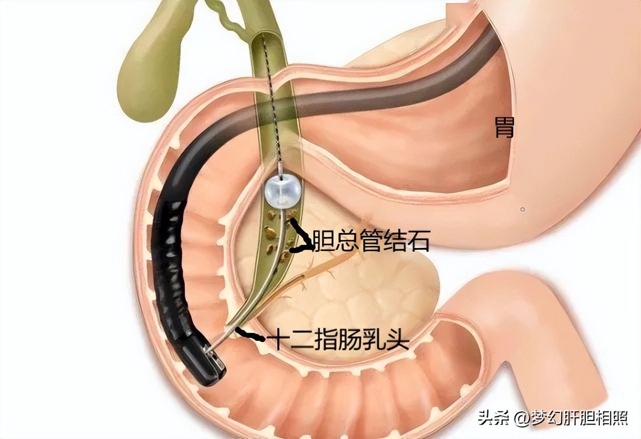 什么是微创手术机器,什么是微创手术是大手术