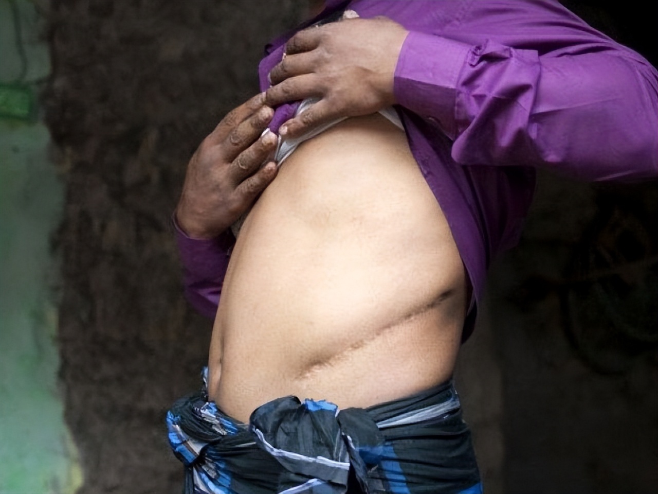 尼泊尔的单肾村,尼泊尔单肾村