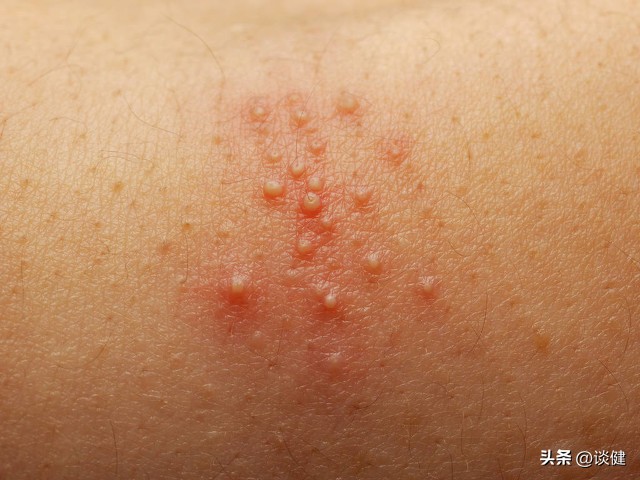 阴道痒有分泌物是什么症状,阴道痒分泌物多什么症状