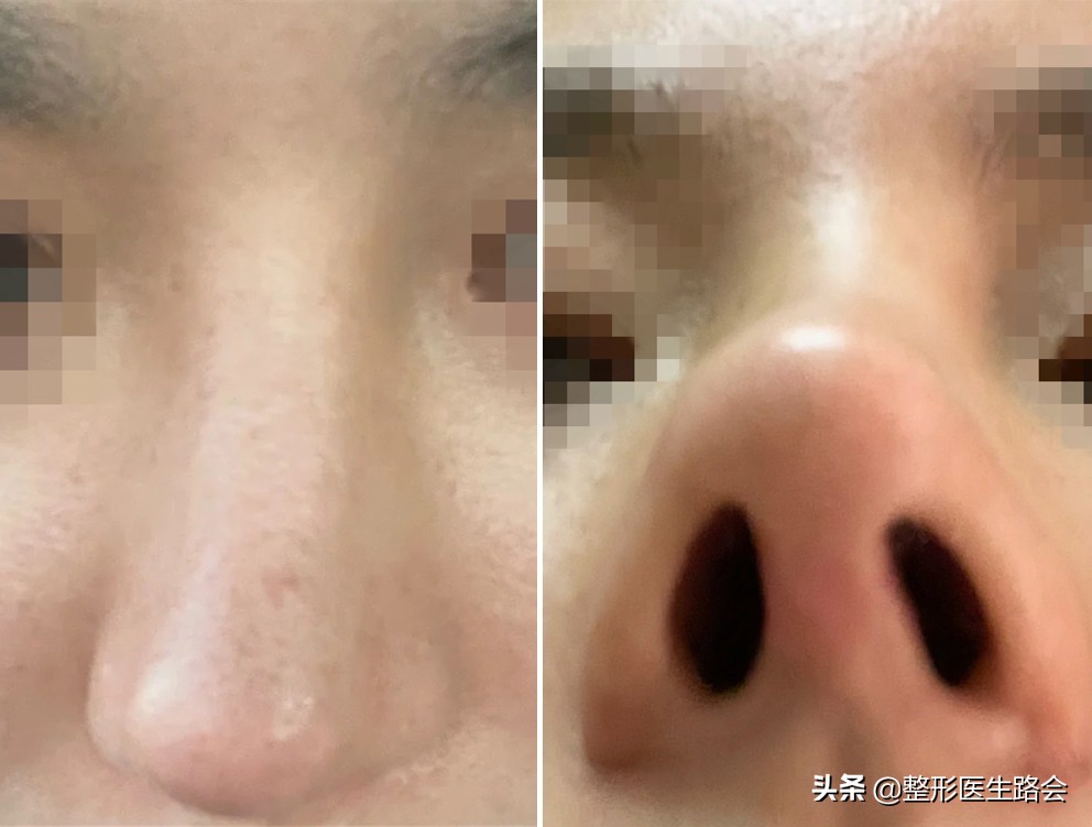 三甲医院鼻整形医生,鼻子整形医生科普类视频