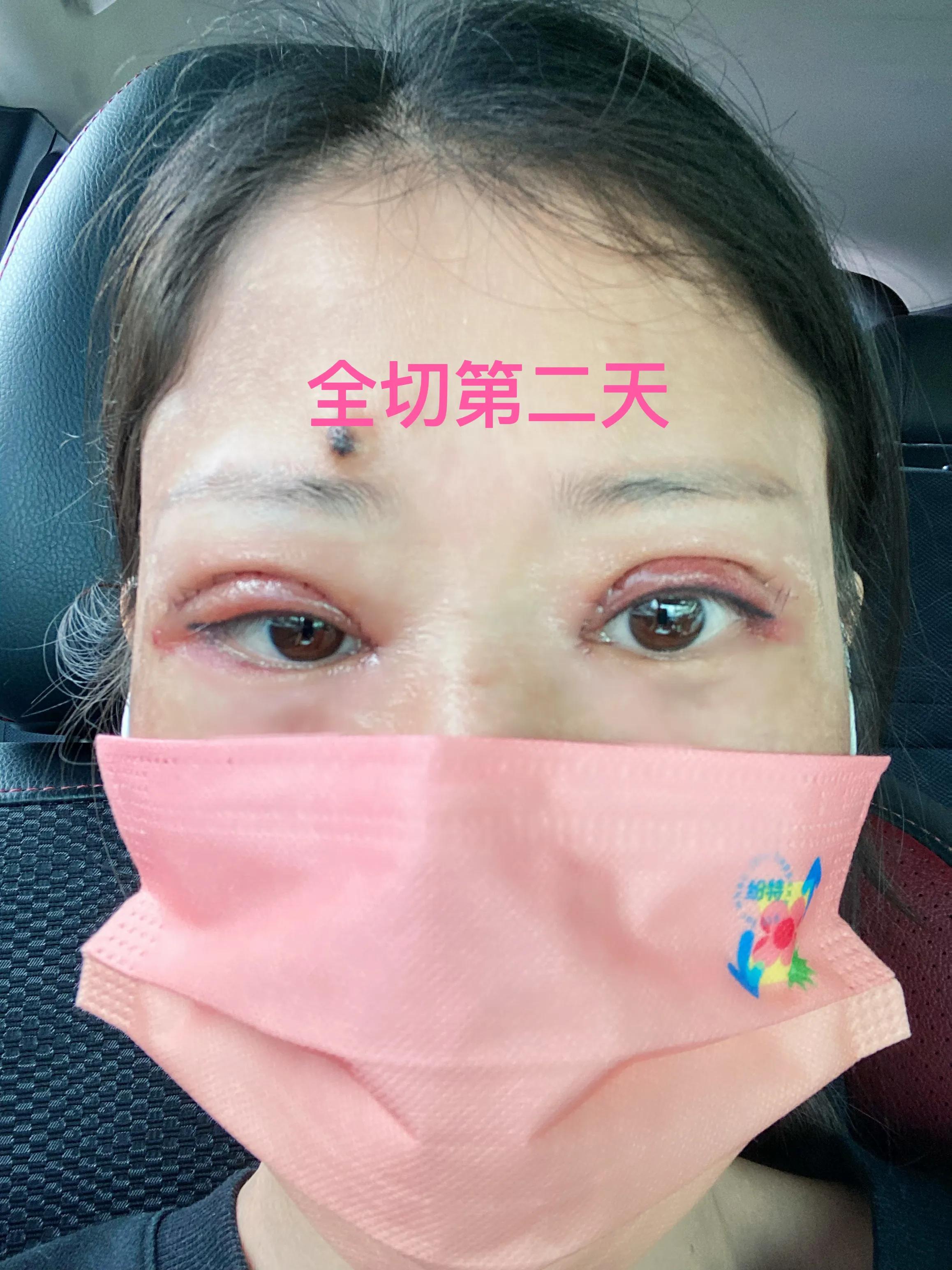 做双眼皮恢复期间能吃红糖吗,恢复最快的双眼皮