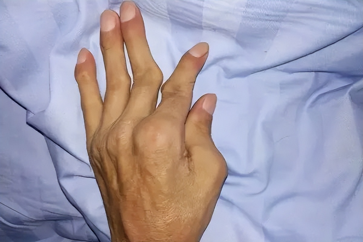 类风湿病的症状和治疗方法,类风湿和痛风的最快治疗方法