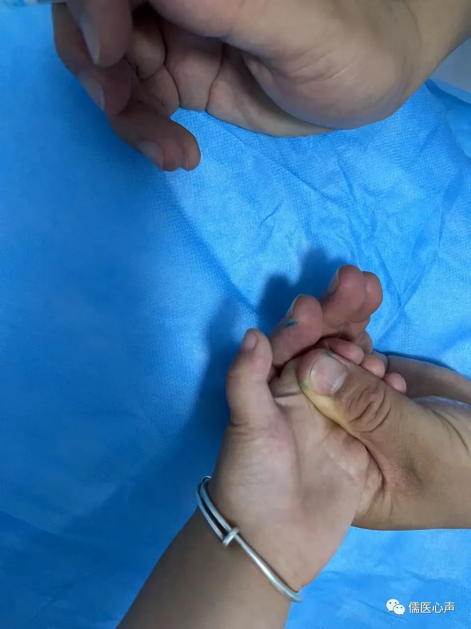 女童大拇指不能伸直,女宝三岁大拇指伸不直用做手术吗