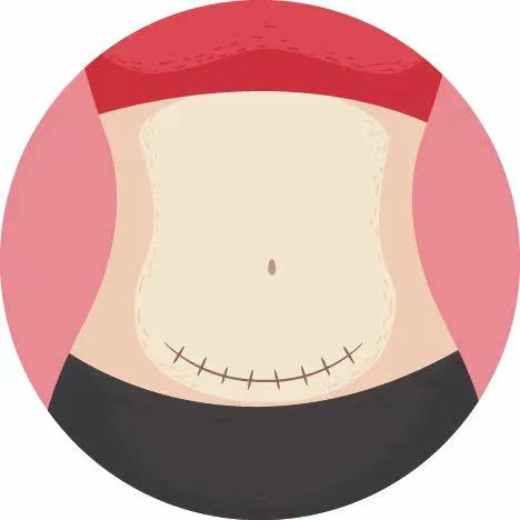 剖腹产疤痕宝妈们用什么修复,剖宫产疤痕憩室怎么去除