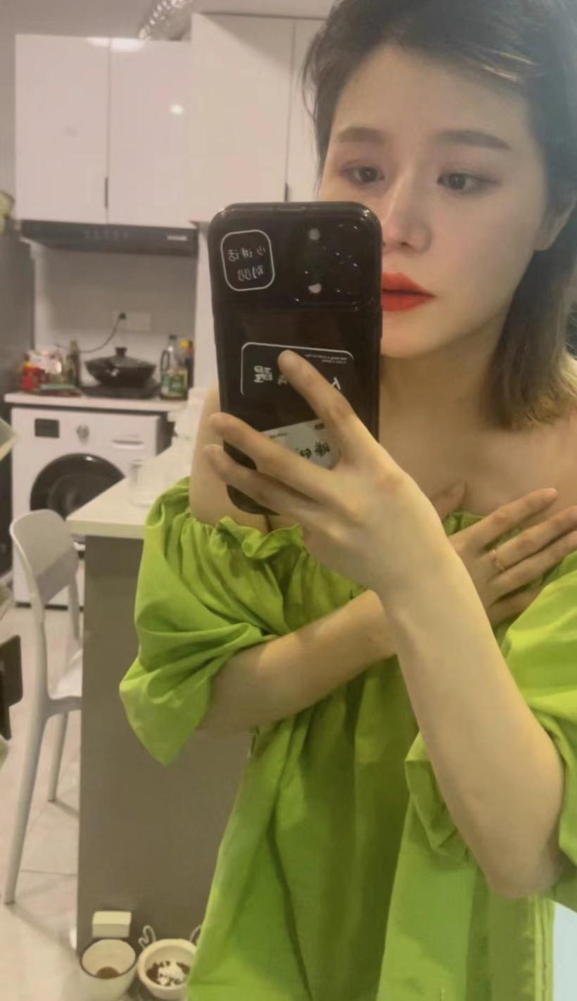 猪鼻整形手术,鼻头肥大鼻子整形成功案例