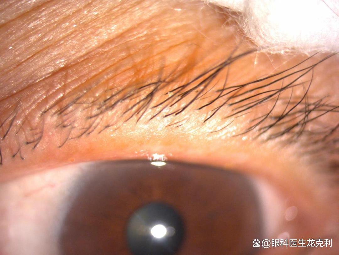 眼睛会看到虫子是什么原因,眼睛里面有虫子的特征