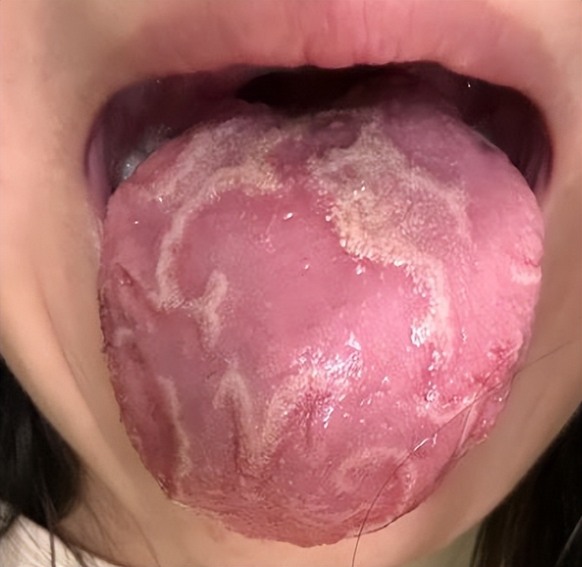 花剥舌或地图舌如何治疗,花剥苔西医怎么治疗