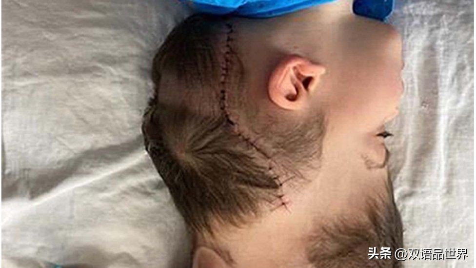 头颅分离连体婴,世界首例连体婴分头颅术