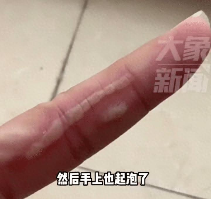 硫酸虫咬了怎么处理,硫酸虫导致皮肤损伤处理