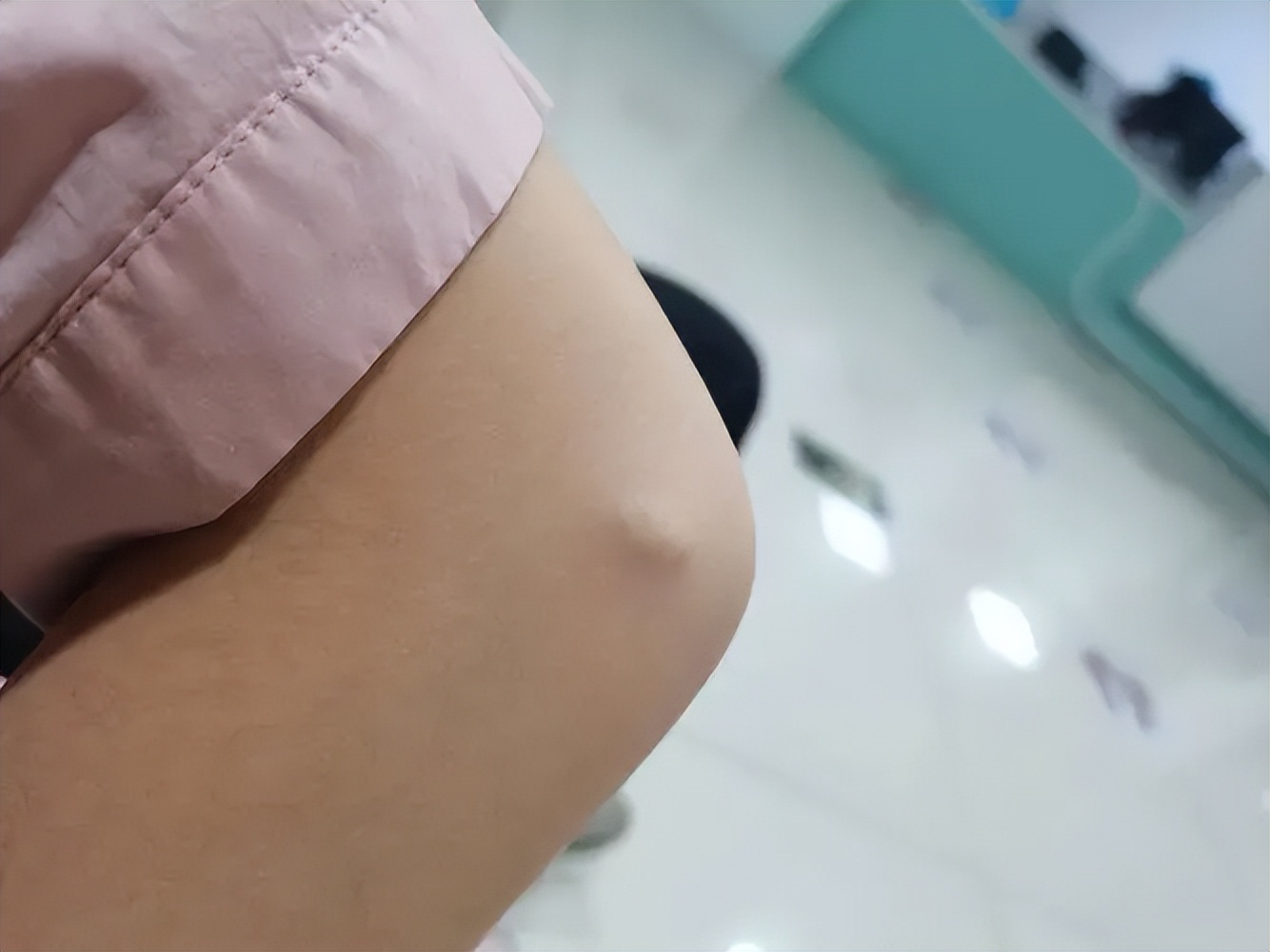 脖子和腋下总长“小肉粒”？可以用手揪吗？医生：与7种疾病有关