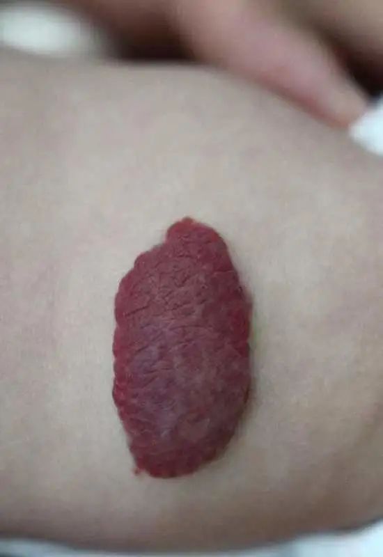 顺义市妇幼医院最新消息,血管瘤诊疗进展