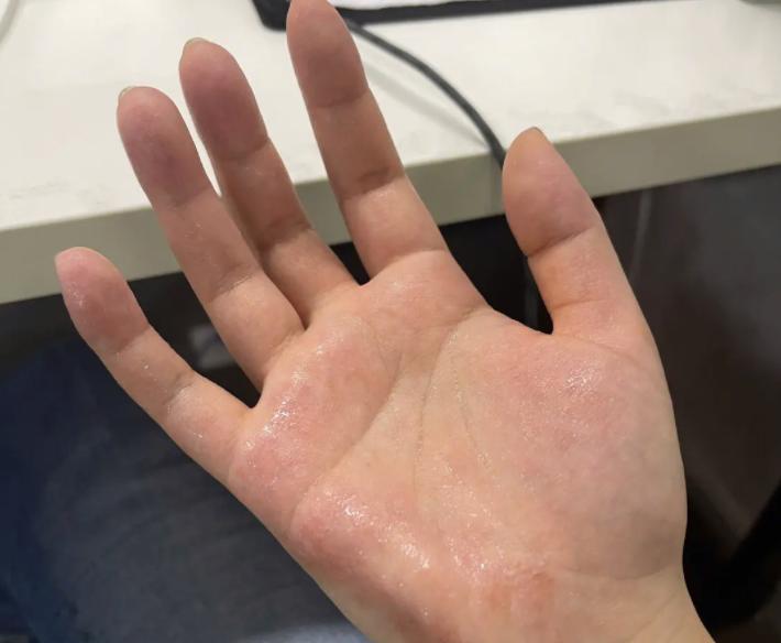 头汗多找胃，手汗多找心，腿汗多找肝，中医教你如何快速止汗