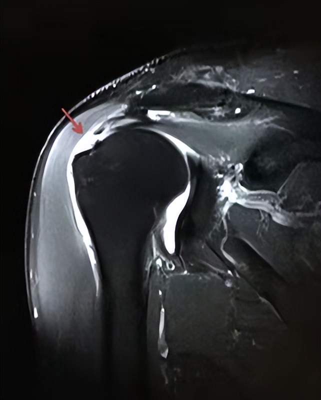 肩部腱膜炎,肩胛冈上肌腱炎的治疗