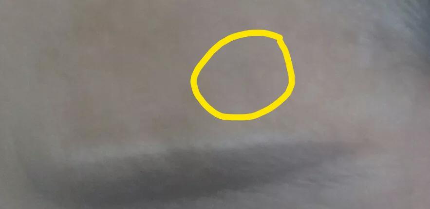 药水点斑有没有点好的呢,药水点斑的亲身经历