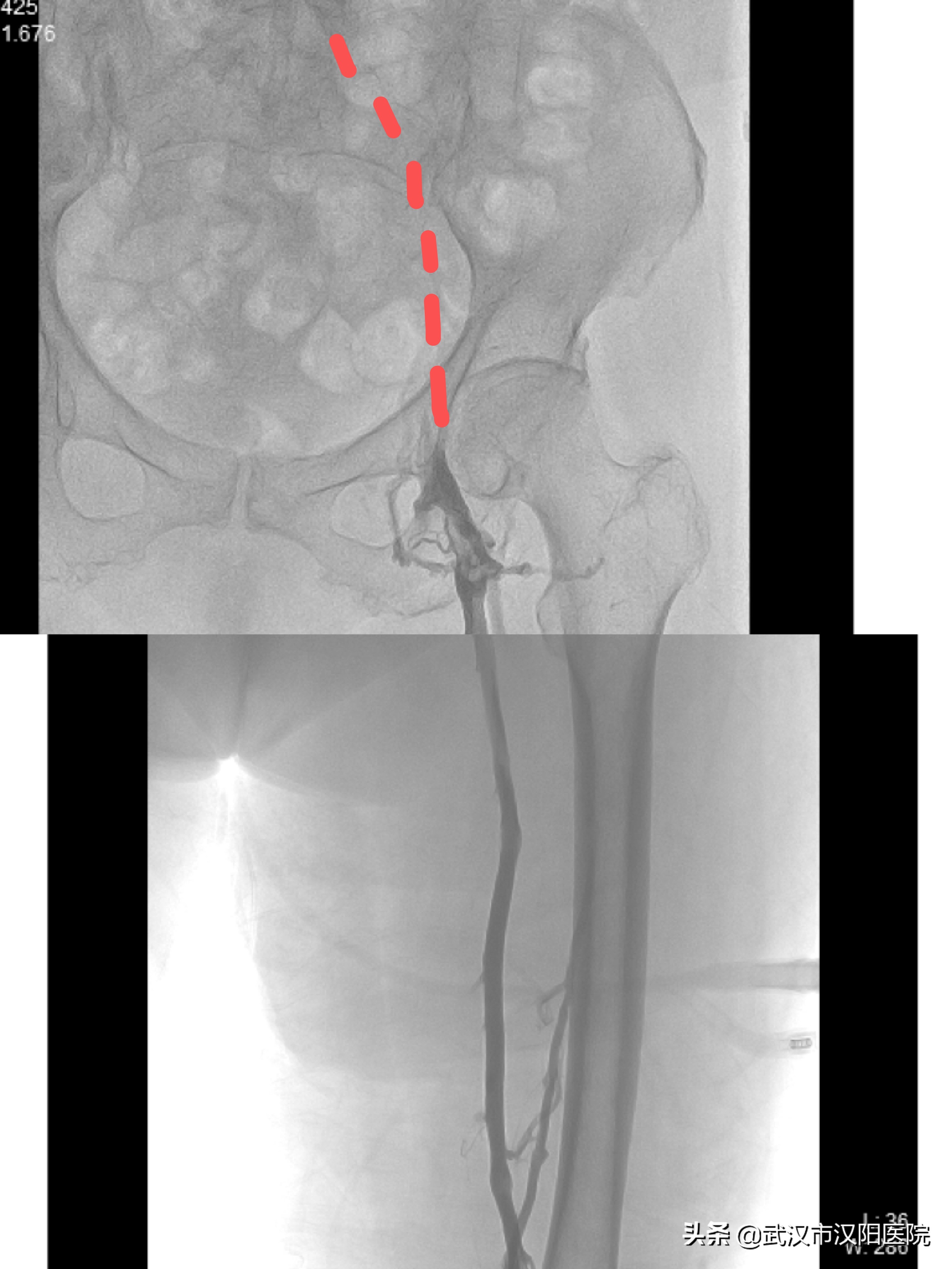 93老年人腿上有血栓怎么治,92岁老人腿血栓手术成功率有多高