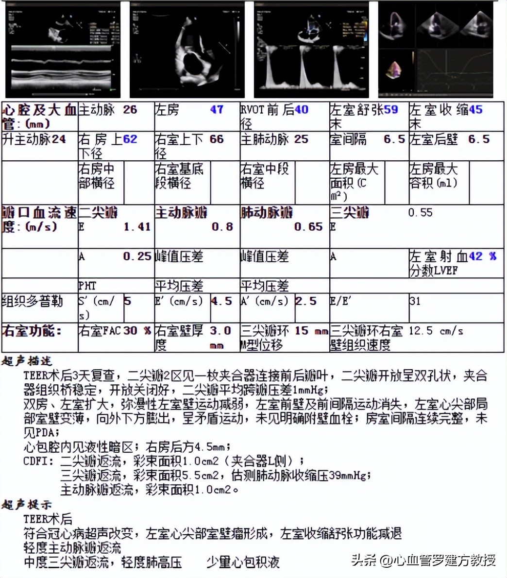 二尖瓣狭窄病例分享,二尖瓣病理生理及治疗方法