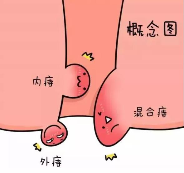 菊部疼痛,难以启齿的痛是什么