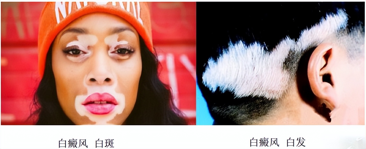 皮肤色素减退和白癜风有什么区别,白癜风是不是色素性皮肤病